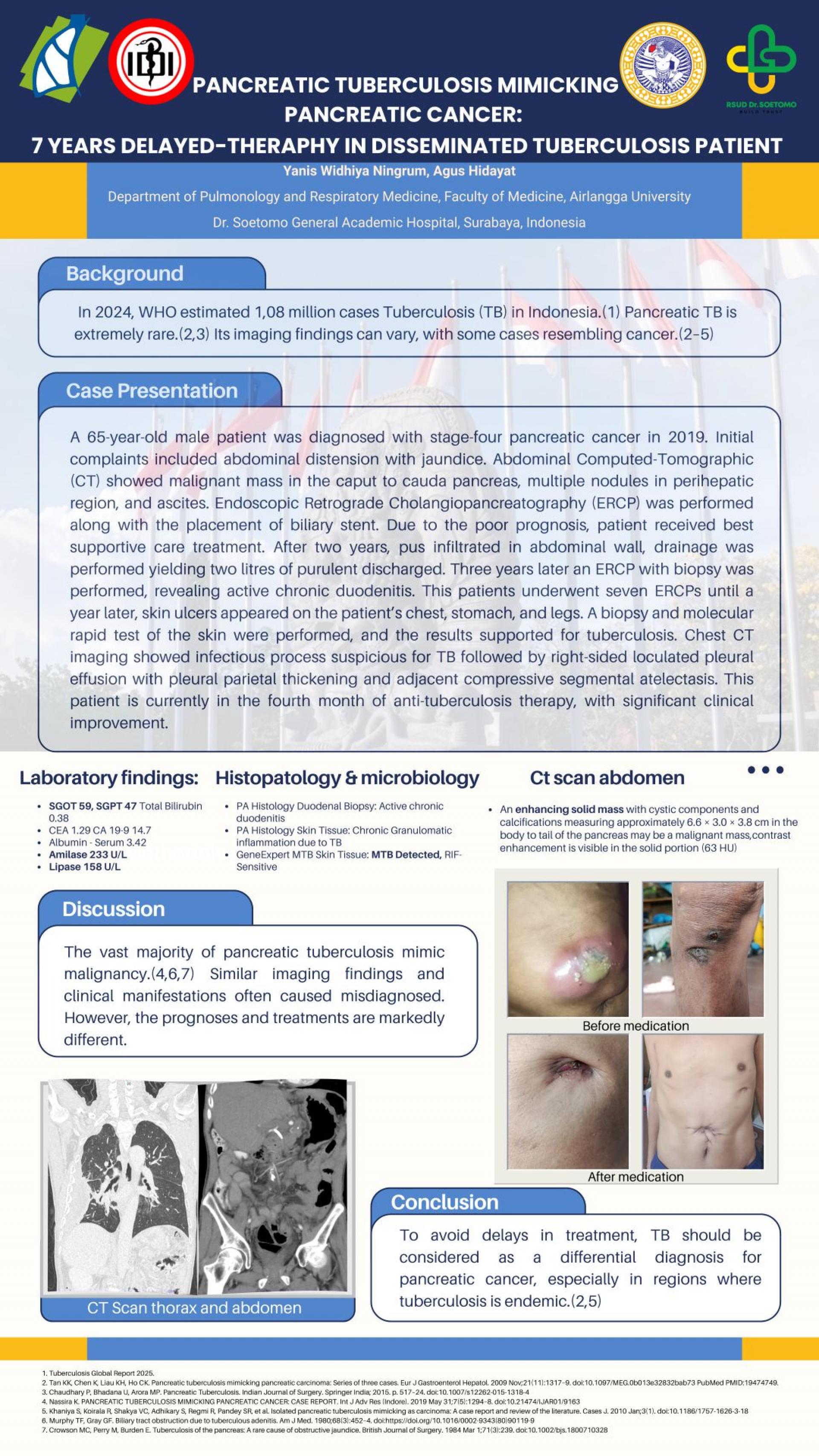 PANCREATIC TUBERCULOSIS MIMICKING PANCREATIC CANCER_ 7 YEARS DELAYED-THERAPHY IN DISSEMINATED TUBERCULOSIS PATIENT