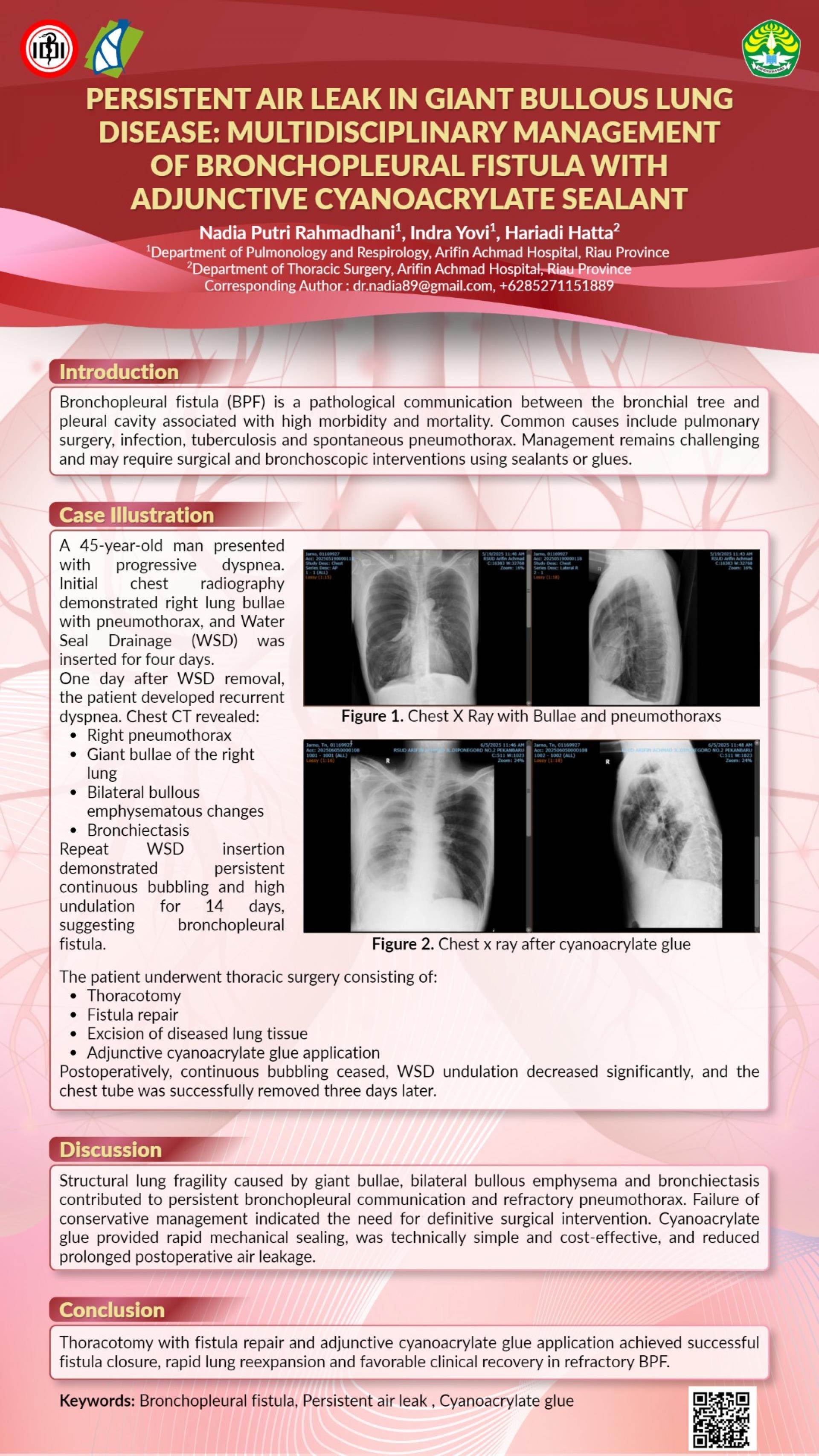 PERSISTENT AIR LEAK IN GIANT BULLOUS LUNG DISEASE_ MULTIDISCIPLINARY MANAGEMENT OF BRONCHOPLEURAL FISTULA WITH ADJUNCTIVE CYANOACRYLATE SEALANT