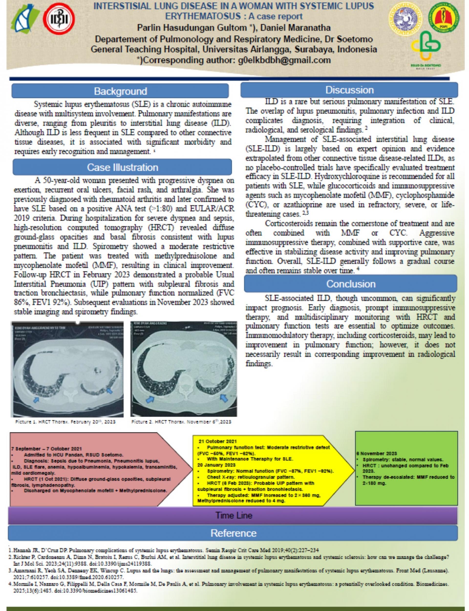INTERSTISIAL LUNG DISEASE IN A WOMAN WITH SYSTEMIC LUPUS ERYTHEMATOSUS