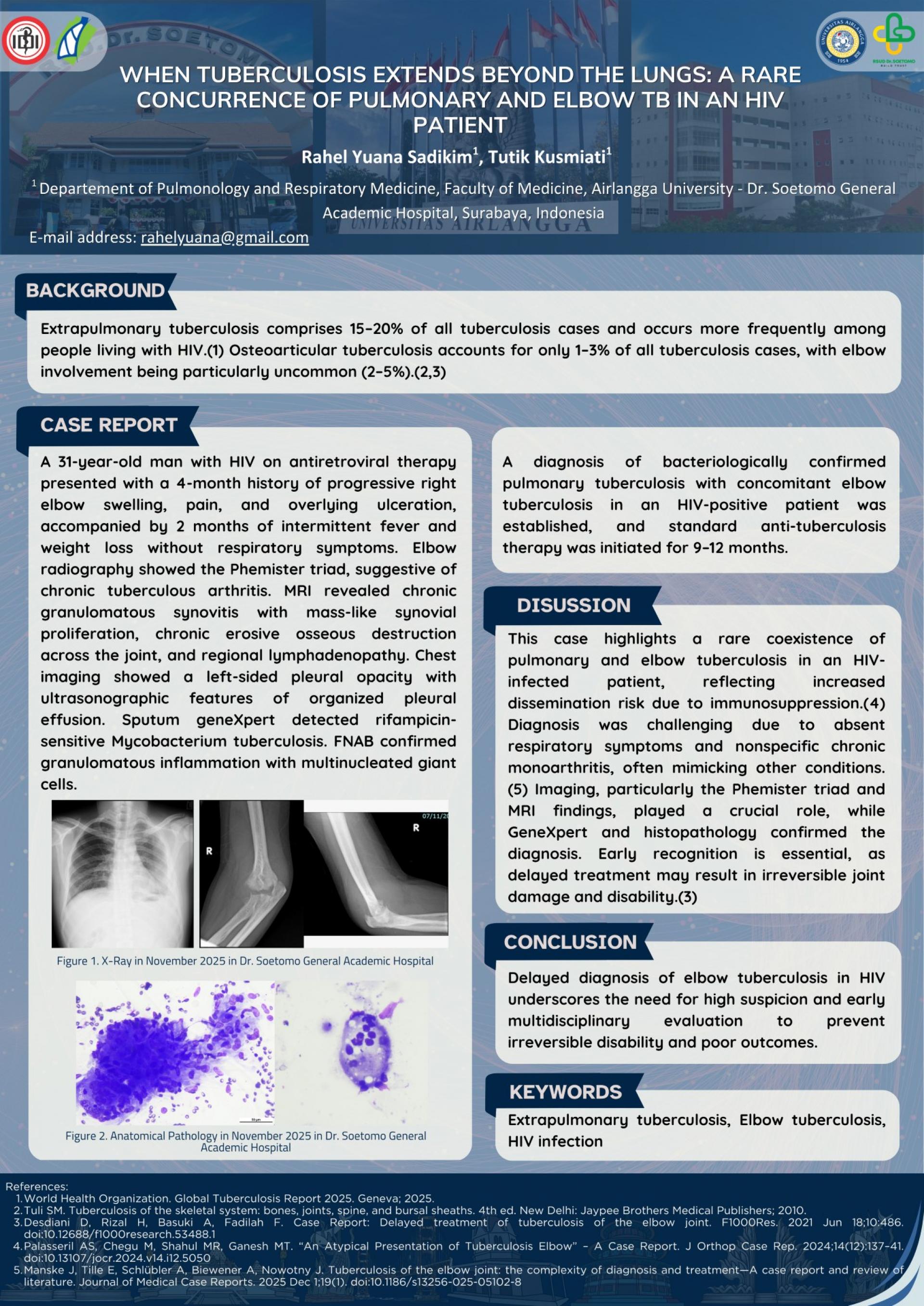 When Tuberculosis Extends Beyond the Lungs_ A Rare Concurrence of Pulmonary and Elbow TB in an HIV Patient
