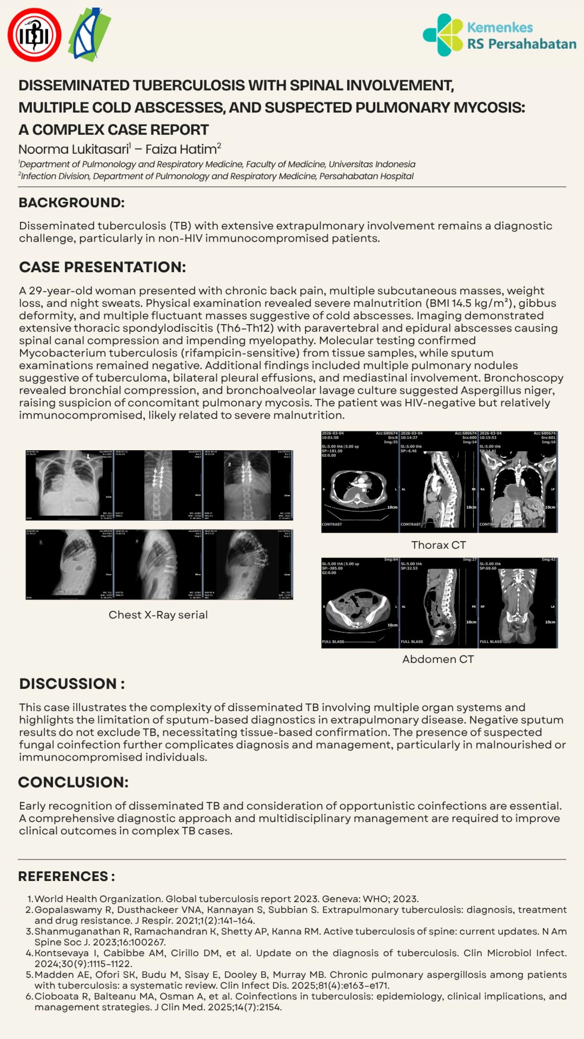 Disseminated Tuberculosis with Spinal Involvement, Multiple Cold Abscesses, and Suspected Pulmonary Mycosis_ A Complex Case Report