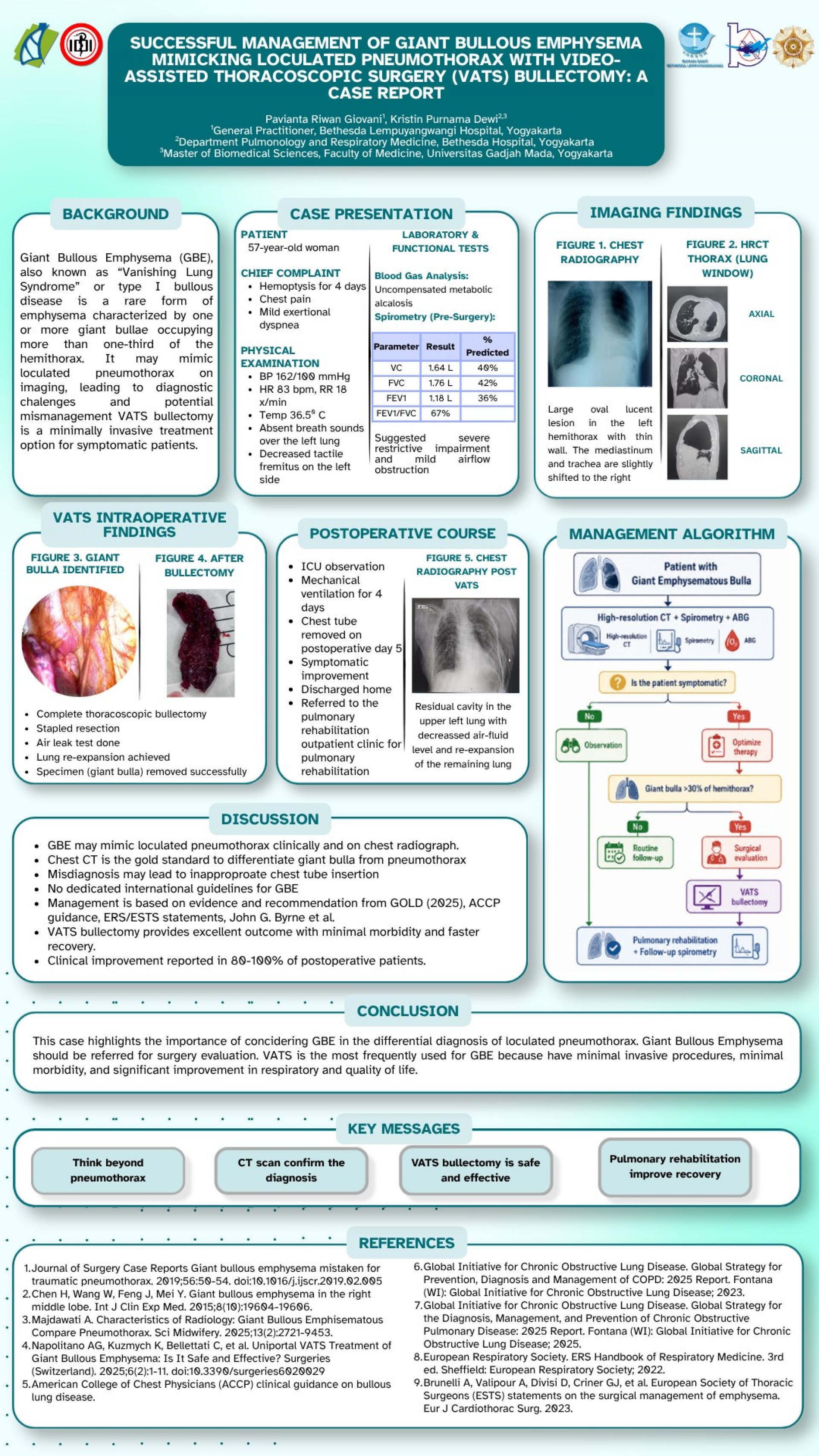SUCCESSFUL MANAGEMENT OF GIANT BULLOUS EMPHYSEMA MIMICKING LOCULATED PNEUMOTHORAX WITH VIDEO-ASSISTED THORACOSCOPIC SURGERY (VATS) BULLECTOMY_ A CASE REPORT