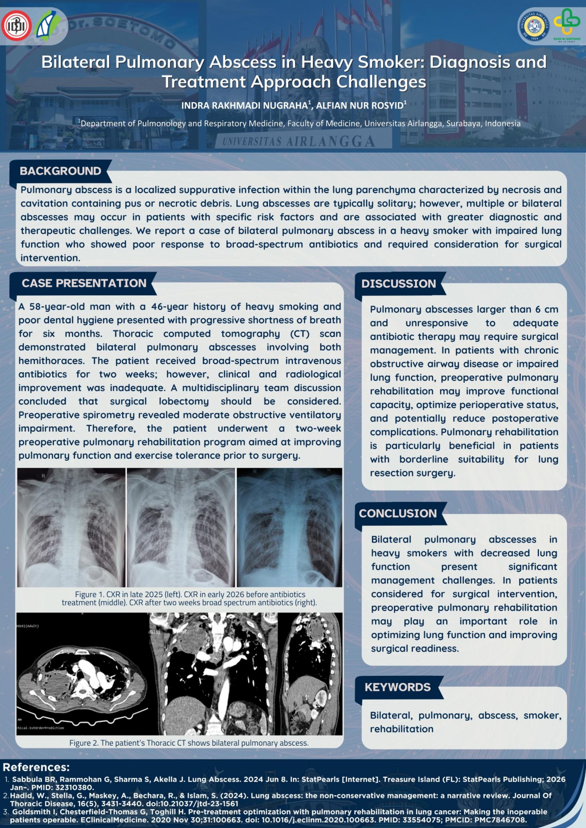 Bilateral Pulmonary Abscess in Heavy Smoker_ Diagnosis and Treatment Approach Challanges