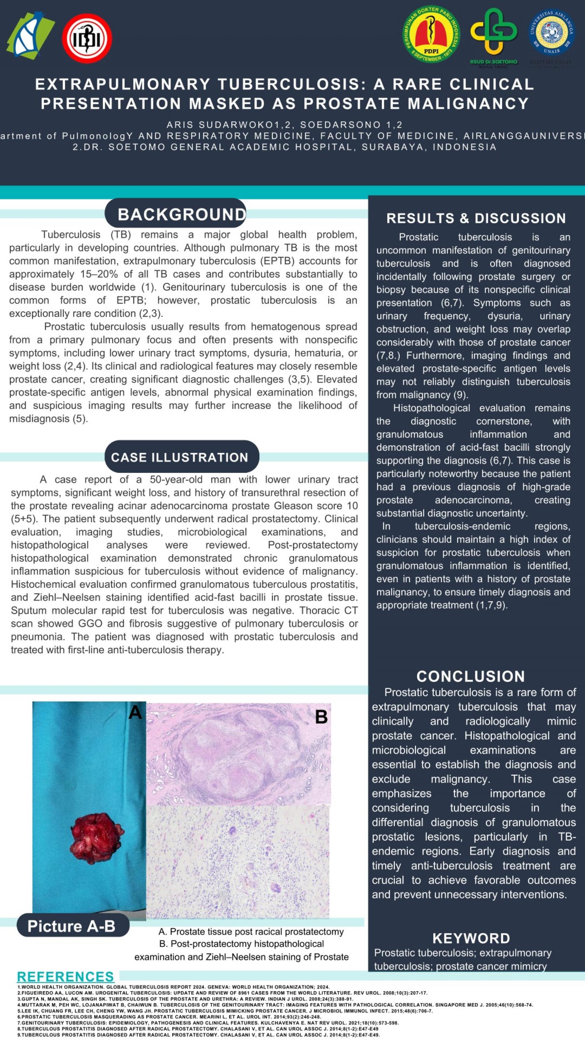 Extrapulmonary Tuberculosis_ A Rare Clinical Presentation Masked as Prostate Malignancy